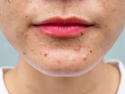 Finding the Right Pimple Treatment for Your Skin Type