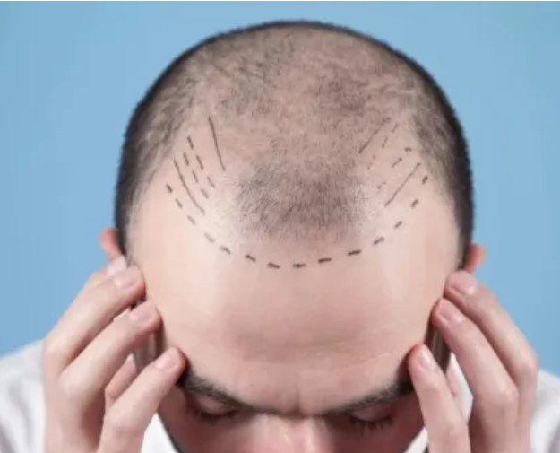 Understanding Hair Loss and Practical Solutions: Why Hair Replacement Systems Are the Most Effective Option